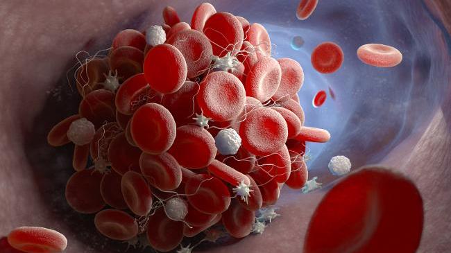 Blood clot (Source: Tatiana Shepeleva/shutterstock.com) (refer to: World Haemophilia Day – 15 years of the German Haemophilia Registry)