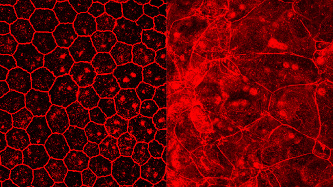 Links: Gesundes retinales Pigmentepithel (RPE); rechts: RPE, in dem Alu-RNA exprimiert wurde. Hier ist die Zerstörung der aneinandergrenzenden zellulären Membranstrukturen sichtbar.