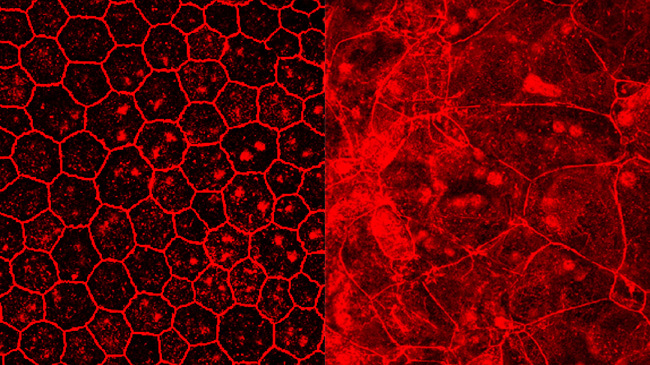 Links: Gesundes retinales Pigmentepithel (RPE); rechts: RPE, in dem Alu-RNA exprimiert wurde. Hier ist die Zerstörung der aneinandergrenzenden zellulären Membranstrukturen sichtbar. Links: Gesundes retinales Pigmentepithel (RPE); rechts: RPE, in dem Alu-RNA exprimiert wurde. Hier ist die Zerstörung der aneinandergrenzenden zellulären Membranstrukturen sichtbar.