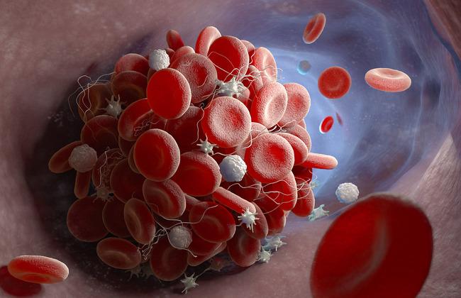 Blood Clot (Source: Tatiana Shepeleva/Shutterstock.com) Blood Clot (Source: Tatiana Shepeleva/Shutterstock.com)